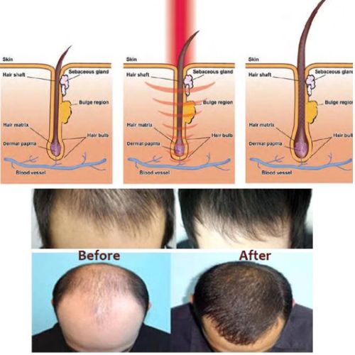 Laser hair growth device