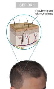 laser hair growth