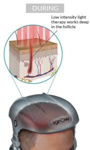 Laser hair growth 