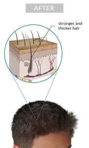 Laser hair growth 