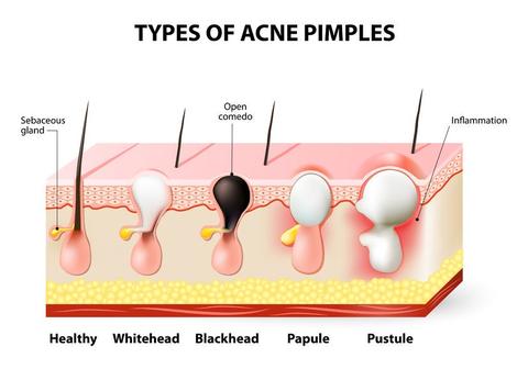 Causes of pimples