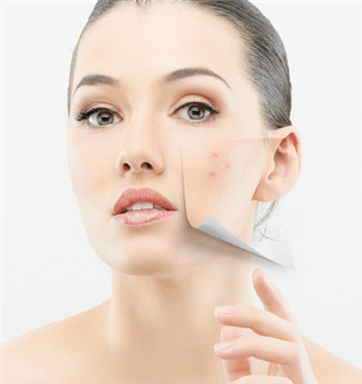 Causes of pimples