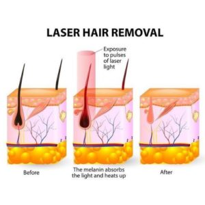 laser hair removal machine