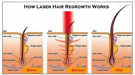 laser hair growth works