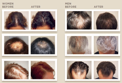 laser hair growth for men and women