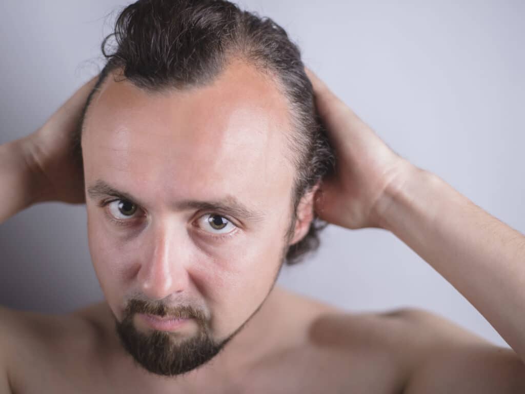 causes of hereditary pattern hair loss