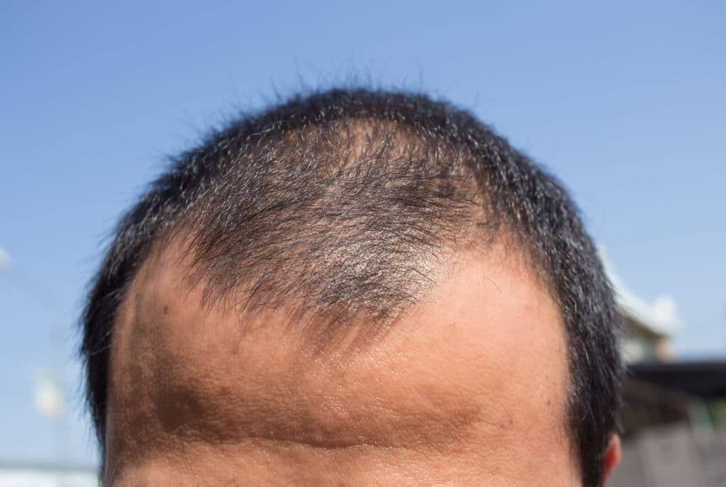 statistics about hair loss