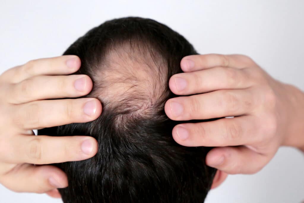 all hair loss is not permanent