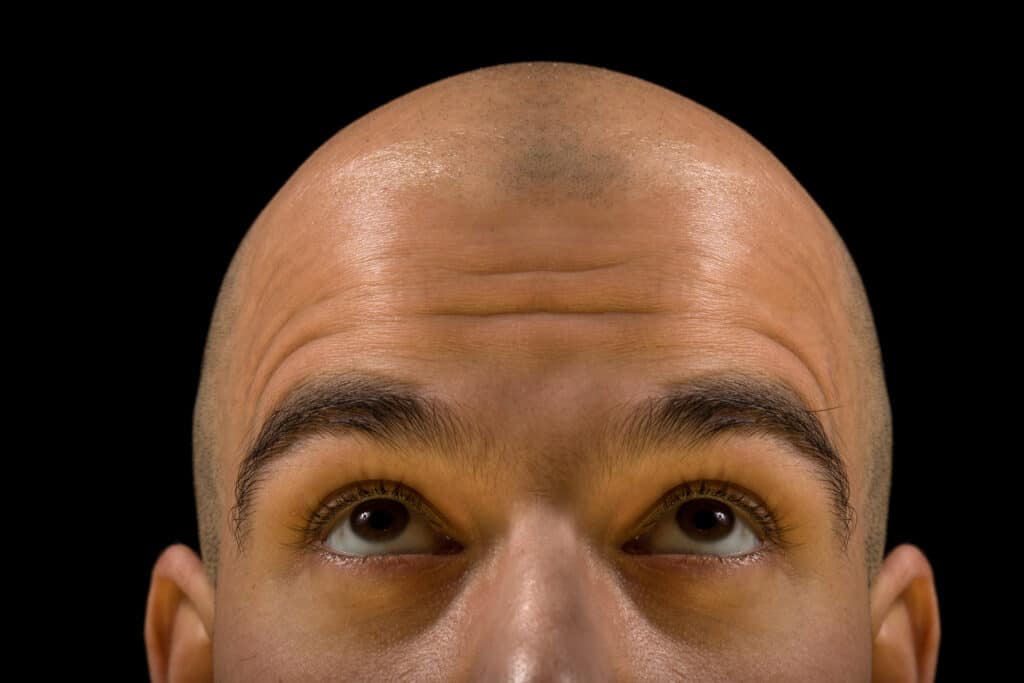 laser hair regrowth caps can cure baldness