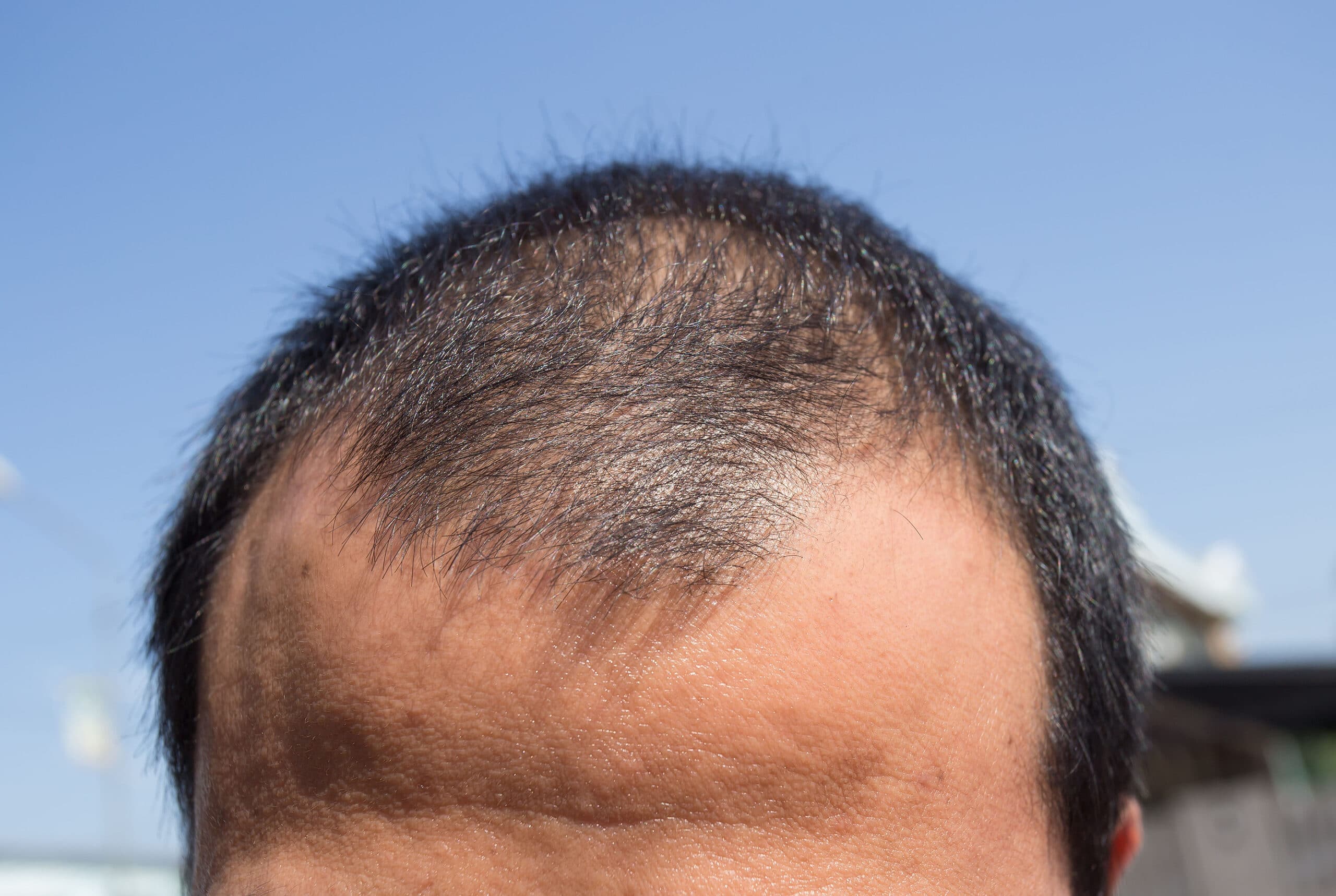 Middleaged Man Concerned With Hair Loss. Baldness. Hair